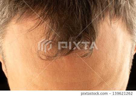 Man with short hair and distinct hairline stands against dark background Man with short hair and distinct hairline stands against dark background 139621262