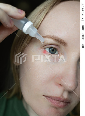 Close-up of a woman applying medical drops to treat a red eye stye or chalazion on the lower eyelid. Healthcare, ophthalmology and infection treatment concept. Close-up of a woman applying medical drops to treat a red eye stye or chalazion on the lower eyelid. Healthcare, ophthalmology and infection treatment concept. 139623698