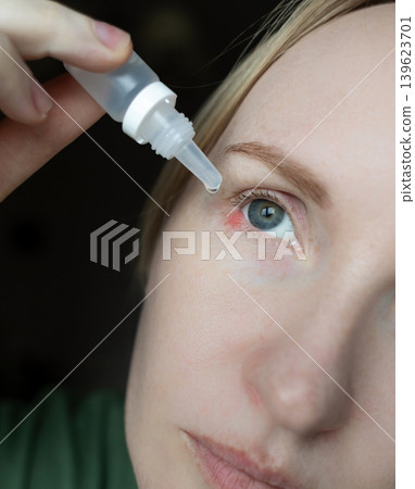 Close-up of a woman applying medical drops to treat a red eye stye or chalazion on the lower eyelid. Healthcare, ophthalmology and infection treatment concept. 139623701