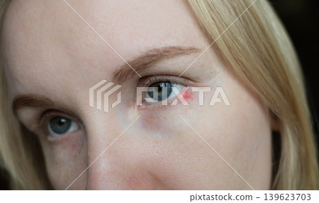 Close-up of a woman applying medical drops to treat a red eye stye or chalazion on the lower eyelid. Healthcare, ophthalmology and infection treatment concept. Close-up of a woman applying medical drops to treat a red eye stye or chalazion on the lower eyelid. Healthcare, ophthalmology and infection treatment concept. 139623703