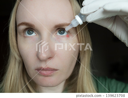 Close-up of a woman applying medical drops to treat a red eye stye or chalazion on the lower eyelid. Healthcare, ophthalmology and infection treatment concept. 139623708