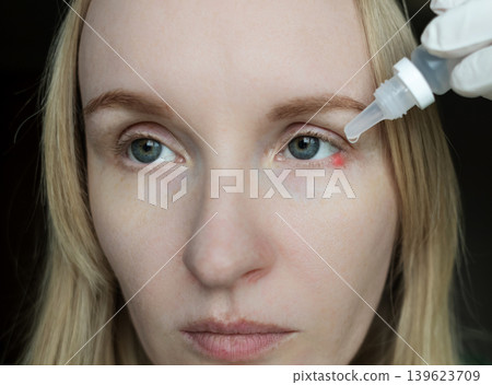 Close-up of a woman applying medical drops to treat a red eye stye or chalazion on the lower eyelid. Healthcare, ophthalmology and infection treatment concept. Close-up of a woman applying medical drops to treat a red eye stye or chalazion on the lower eyelid. Healthcare, ophthalmology and infection treatment concept. 139623709