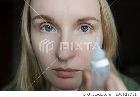 Close-up of a woman applying medical drops to treat a red eye stye or chalazion on the lower eyelid. Healthcare, ophthalmology and infection treatment concept. Close-up of a woman applying medical drops to treat a red eye stye or chalazion on the lower eyelid. Healthcare, ophthalmology and infection treatment concept. 139623711