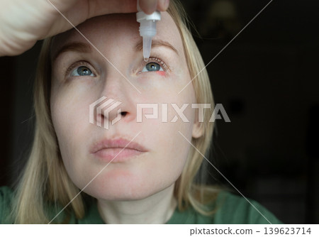 Close-up of a woman applying medical drops to treat a red eye stye or chalazion on the lower eyelid. Healthcare, ophthalmology and infection treatment concept. Close-up of a woman applying medical drops to treat a red eye stye or chalazion on the lower eyelid. Healthcare, ophthalmology and infection treatment concept. 139623714