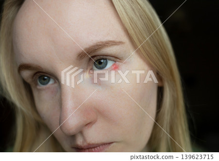 Close-up of a woman applying medical drops to treat a red eye stye or chalazion on the lower eyelid. Healthcare, ophthalmology and infection treatment concept. Close-up of a woman applying medical drops to treat a red eye stye or chalazion on the lower eyelid. Healthcare, ophthalmology and infection treatment concept. 139623715