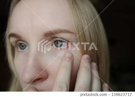 Close-up of a woman applying medical drops to treat a red eye stye or chalazion on the lower eyelid. Healthcare, ophthalmology and infection treatment concept. Close-up of a woman applying medical drops to treat a red eye stye or chalazion on the lower eyelid. Healthcare, ophthalmology and infection treatment concept. 139623717