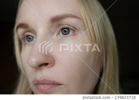 Close-up of a woman applying medical drops to treat a red eye stye or chalazion on the lower eyelid. Healthcare, ophthalmology and infection treatment concept. Close-up of a woman applying medical drops to treat a red eye stye or chalazion on the lower eyelid. Healthcare, ophthalmology and infection treatment concept. 139623718