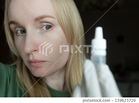 Close-up of a woman applying medical drops to treat a red eye stye or chalazion on the lower eyelid. Healthcare, ophthalmology and infection treatment concept. Close-up of a woman applying medical drops to treat a red eye stye or chalazion on the lower eyelid. Healthcare, ophthalmology and infection treatment concept. 139623720