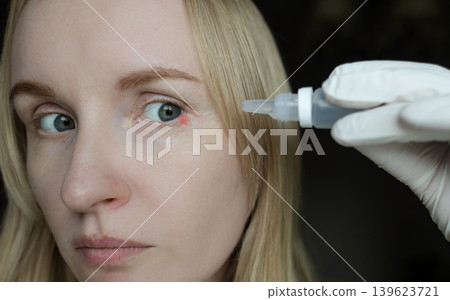 Close-up of a woman applying medical drops to treat a red eye stye or chalazion on the lower eyelid. Healthcare, ophthalmology and infection treatment concept. Close-up of a woman applying medical drops to treat a red eye stye or chalazion on the lower eyelid. Healthcare, ophthalmology and infection treatment concept. 139623721
