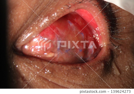 Anophthalmia. Slit-lamp image demonstrating a postoperative anophthalmic socket one week after evisceration, with sutured scleral shell and conjunctival inflammation Anophthalmia. Slit-lamp image demonstrating a postoperative anophthalmic socket one week after evisceration, with sutured scleral shell and conjunctival inflammation 139624273