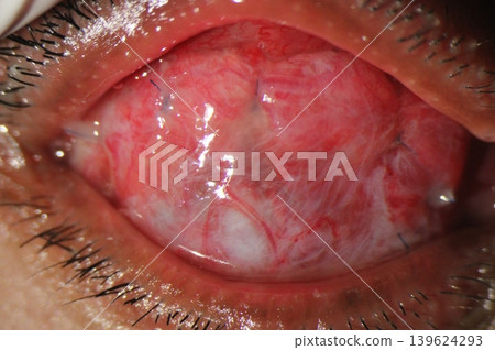Anophthalmia. Post-evisceration anophthalmic socket demonstrating inflamed sutured conjunctiva with conjunctival discharge Anophthalmia. Post-evisceration anophthalmic socket demonstrating inflamed sutured conjunctiva with conjunctival discharge 139624293