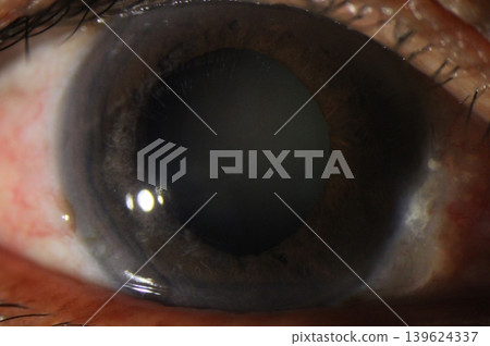 Close-up photograph demonstrating iris atrophy at the pupillary margin with a mid-dilated pupil Close-up photograph demonstrating iris atrophy at the pupillary margin with a mid-dilated pupil 139624337