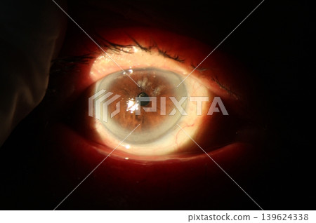 Iris atrophy. Slit-lamp photograph showing a localized area of iris stromal thinning and depigmentation, consistent with postoperative sectoral iris atrophy 139624338