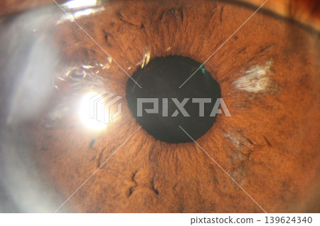 Slit lamp image demonstrating multifocal iris atrophy surrounding the pupillary margin 139624340