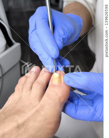 A master podologist treats an ingrown toenail on the big toe. A master podologist treats an ingrown toenail on the big toe. 139626598