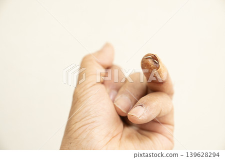 The ring finger of my left hand is fractured and has a steel wire inserted. The ring finger of my left hand is fractured and has a steel wire inserted. 139628294