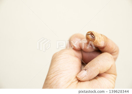 The ring finger of my left hand is fractured and has a steel wire inserted. 139628344