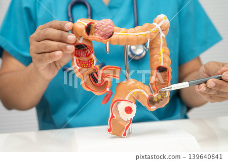 Colorectal cancer, doctor holding intestine colon human model. 139640841
