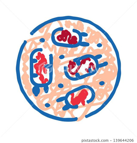 Blood clot forming in human artery causing thrombosis Blood clot forming in human artery causing thrombosis 139644206