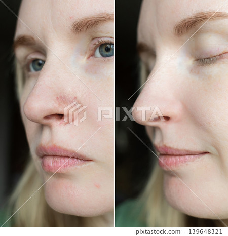 Before and after laser couperose removal on nose. Result of IPL therapy for facial vascular redness, capillaries coagulation and skin rejuvenation. Before and after laser couperose removal on nose. Result of IPL therapy for facial vascular redness, capillaries coagulation and skin rejuvenation. 139648321