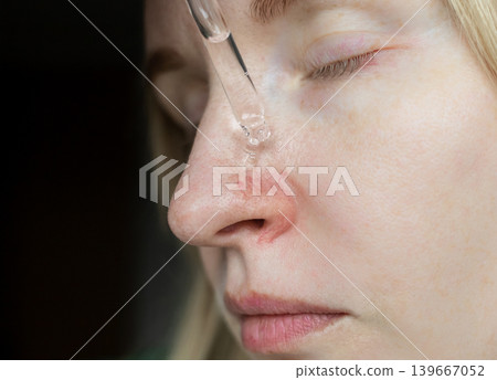 Close-up of woman applying serum with pipette on face with couperose and rosacea symptoms on nose. Professional skincare treatment for dilated capillaries and redness. Close-up of woman applying serum with pipette on face with couperose and rosacea symptoms on nose. Professional skincare treatment for dilated capillaries and redness. 139667052