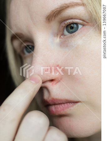 Close-up of a woman's nose with couperose and rosacea, visible dilated capillaries and vascular network. Skin redness and telangiectasia needing dermatological treatment or laser removal. Close-up of a woman's nose with couperose and rosacea, visible dilated capillaries and vascular network. Skin redness and telangiectasia needing dermatological treatment or laser removal. 139667087