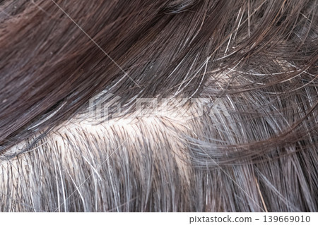 Image of a dirty scalp Image of a dirty scalp 139669010