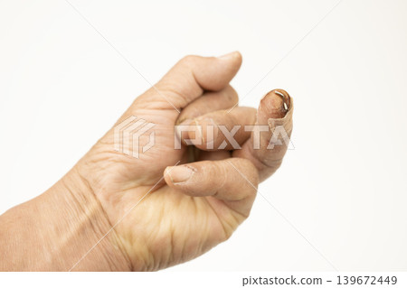 我左手無名指骨折了,裡面植入了一根鋼絲。 我左手無名指骨折了,裡面植入了一根鋼絲。 139672449