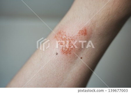 我手臂上的傷口流膿了。 我手臂上的傷口流膿了。 139677003