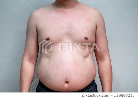 The symptom of Dengue fever on skin of a man 39 years old, the detail of red spots and rash on the skin of a man in the recovery phase. The symptom of Dengue fever on skin of a man 39 years old, the detail of red spots and rash on the skin of a man in the recovery phase. 139697233