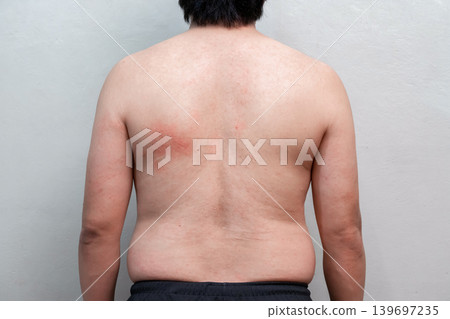 The symptom of Dengue fever on skin of a man 39 years old, the detail of red spots and rash on the skin of a man in the recovery phase. The symptom of Dengue fever on skin of a man 39 years old, the detail of red spots and rash on the skin of a man in the recovery phase. 139697235