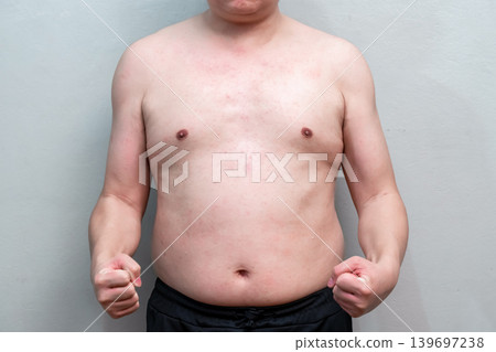 The symptom of Dengue fever on skin of a man 39 years old, the detail of red spots and rash on the skin of a man in the recovery phase. 139697238