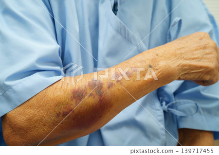 Ecchymosis, elderly bleeding on her arm after taking aspirin. Ecchymosis, elderly bleeding on her arm after taking aspirin. 139717455