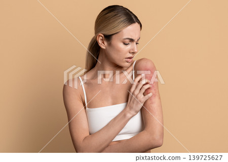 Young woman scratching her red irritated arm skin with worried look 139725627