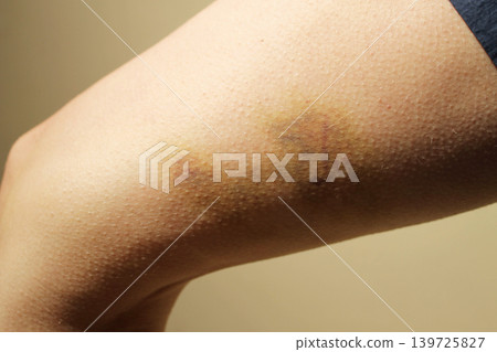 bruise bruise 139725827