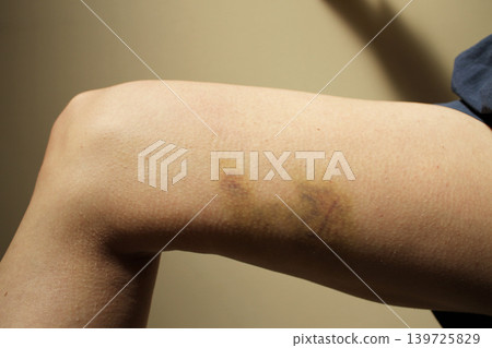 bruise 139725829