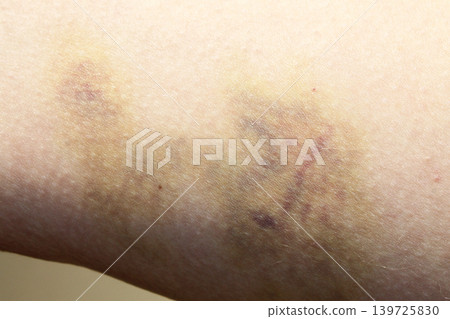 bruise 139725830