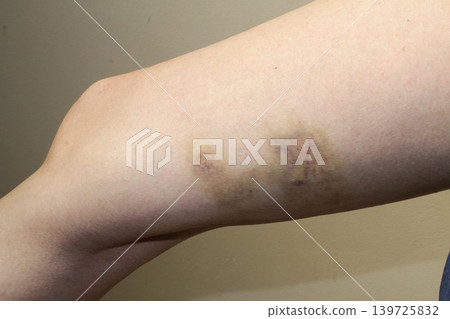 bruise 139725832