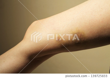 bruise bruise 139725833
