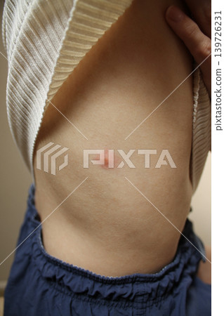 insect bite insect bite 139726231