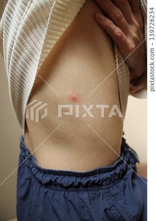 insect bite 139726234