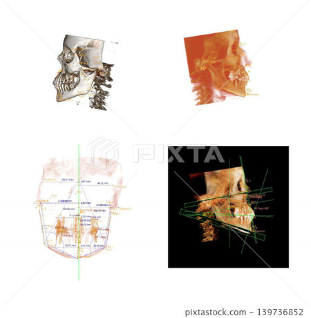 Computed tomography of adult female patient with Temporomandibular joint (TMJ, joint of lower jaw). Dental x-ray of an adult patient showing teeth, jaws and mandibular joint. Modern digital tomography Computed tomography of adult female patient with Temporomandibular joint (TMJ, joint of lower jaw). Dental x-ray of an adult patient showing teeth, jaws and mandibular joint. Modern digital tomography 139736852
