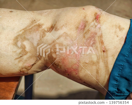 Healing stage of second-degree burn scar from scalding water on human skin. Healing stage of second-degree burn scar from scalding water on human skin. 139756354