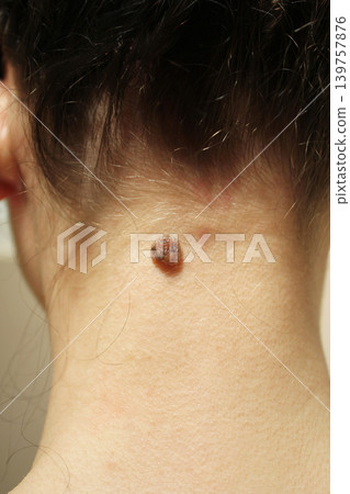 mole mole 139757876