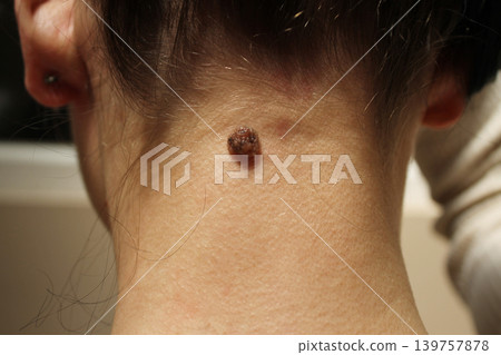mole mole 139757878