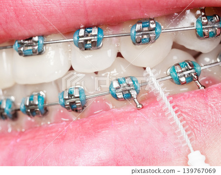 Woman brushing teeth with braces using brush 139767069