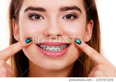 Woman showing her teeth with braces Woman showing her teeth with braces 139767209