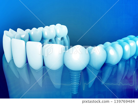 Tooth anatomy with dental implant 139769484
