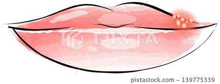 cold sore 139775339
