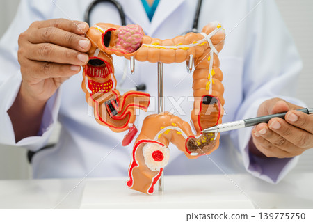 Colorectal cancer, doctor holding intestine colon human anatomy model. 139775750